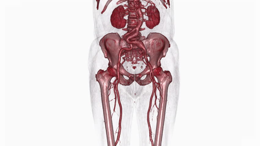 Header of Abdominal Aortic Aneurysm