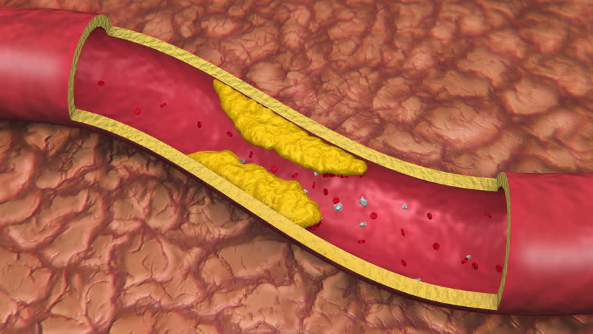 Clogged Artery Low Angle Digital Animation With Platelets And