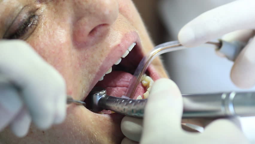 Close-up Of Dentist Using Dental Drill On Patient's Teeth Stock Footage