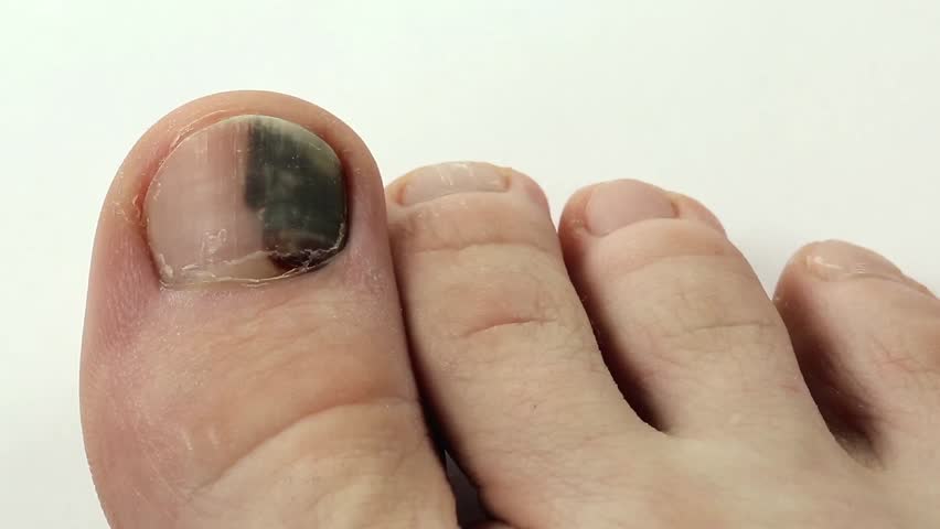 Trauma Of Toenail. Subungual Hematoma. Bruise Under The Nail Of Big Toe ...